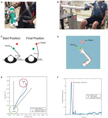 The Upper Extremity Flexion Synergy Is Minimally Expressed in Young Individuals With Unilateral Cerebral Palsy Following an Early Brain Injury